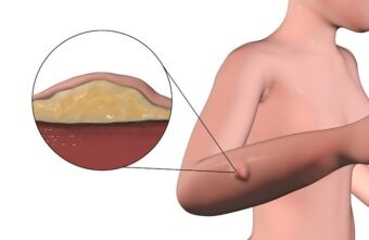 Lipom – ce este și cum poate fi tratat