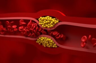 Ateroscleroza – cauze, simptome, complicații, regim alimentar